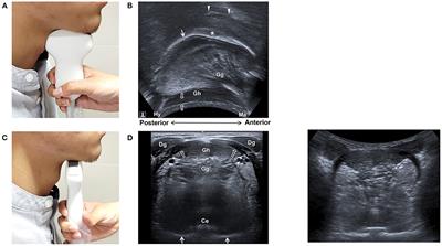 Emerging Role of Ultrasound in Dysphagia Assessment and Intervention: A Narrative Review